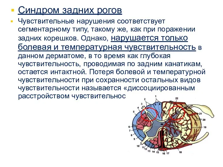 Синдром задних рогов Чувствительные нарушения соответствует сегментарному типу, такому же, как