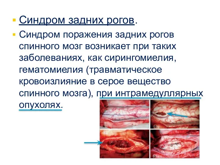 Синдром задних рогов. Синдром поражения задних рогов спинного мозг возникает при