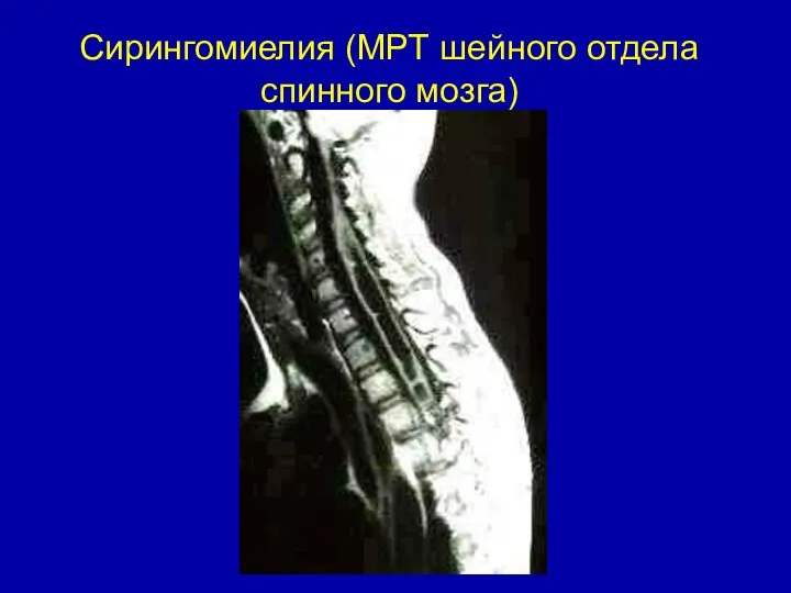 Сирингомиелия (МРТ шейного отдела спинного мозга)