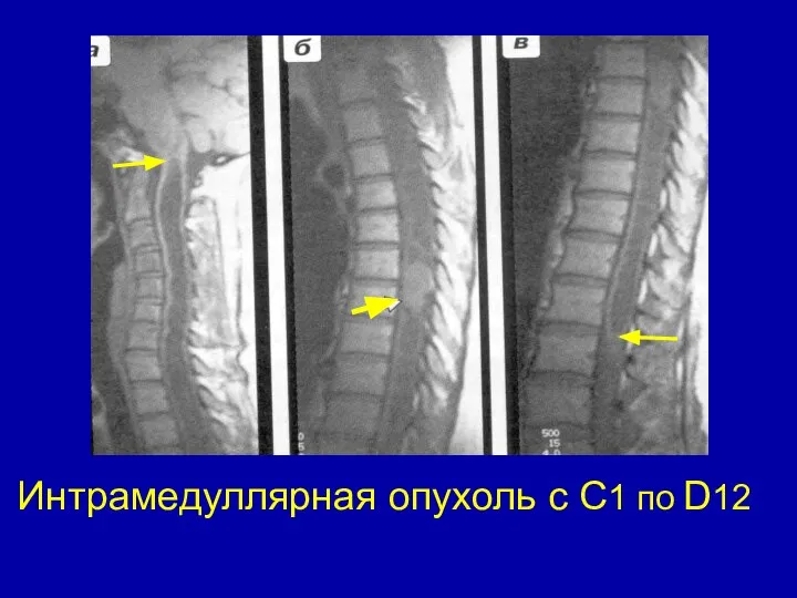 Интрамедуллярная опухоль с С1 по D12