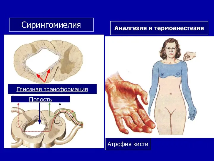 Сирингомиелия Аналгезия и термоанестезия Атрофия кисти Полость Глиозная трансформация