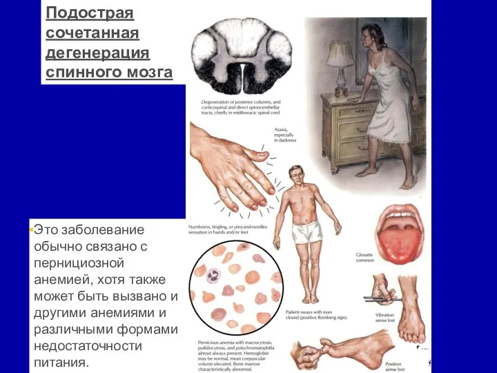 Это заболевание обычно связано с пернициозной анемией, хотя также может быть