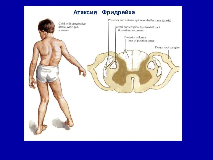 Атаксия Фридрейха