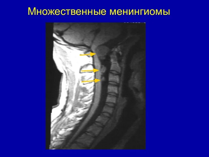 Множественные менингиомы