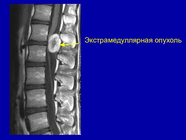 Экстрамедуллярная опухоль