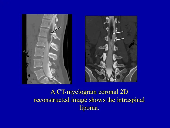 A CT-myelogram coronal 2D reconstructed image shows the intraspinal lipoma.