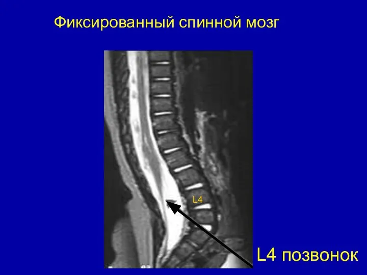 Фиксированный спинной мозг L4 позвонок L4