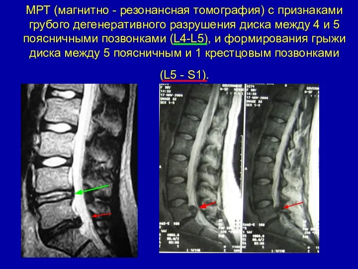 МРТ (магнитно - резонансная томография) с признаками грубого дегенеративного разрушения диска