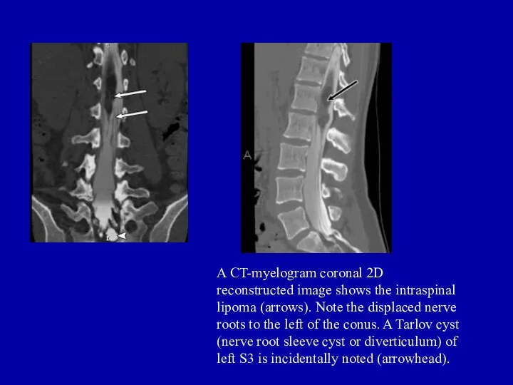 A CT-myelogram coronal 2D reconstructed image shows the intraspinal lipoma (arrows).