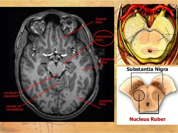 Substantia Nigra Nucleus Ruber