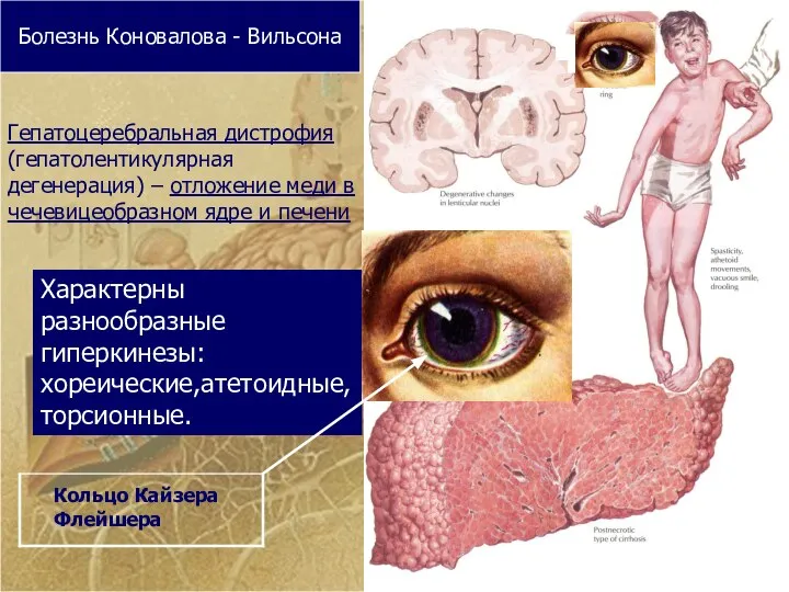 Болезнь Коновалова - Вильсона Гепатоцеребральная дистрофия (гепатолентикулярная дегенерация) – отложение меди