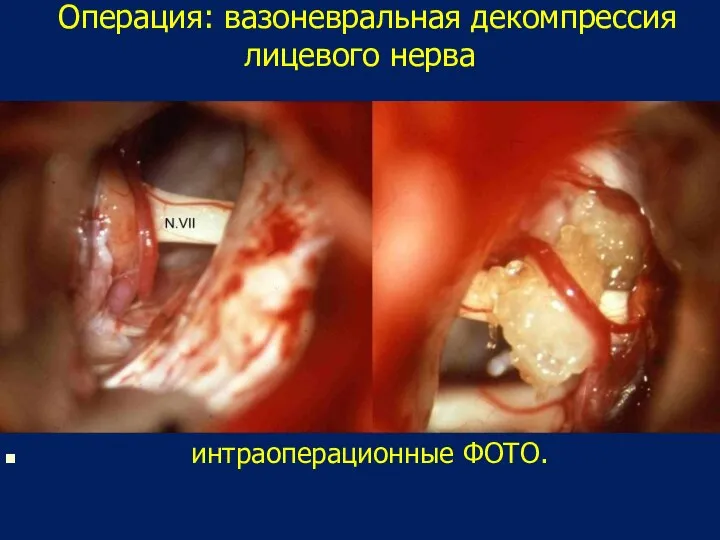 Операция: вазоневральная декомпрессия лицевого нерва интраоперационные ФОТО.