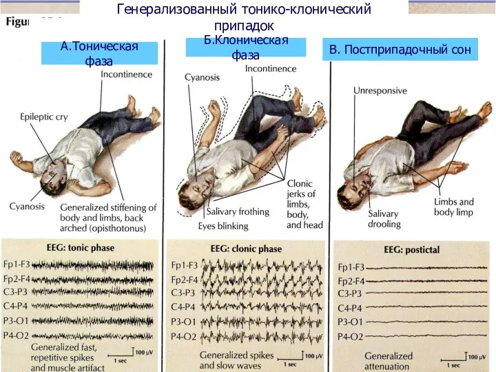 Генерализованный тонико-клонический припадок А.Тоническая фаза Б.Клоническая фаза В. Постприпадочный сон