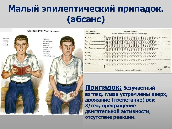 Малый эпилептический припадок. (абсанс) Припадок: безучастный взгляд, глаза устремлены вверх, дрожание