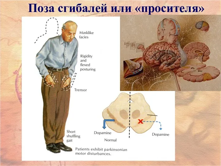 Поза сгибалей или «просителя»