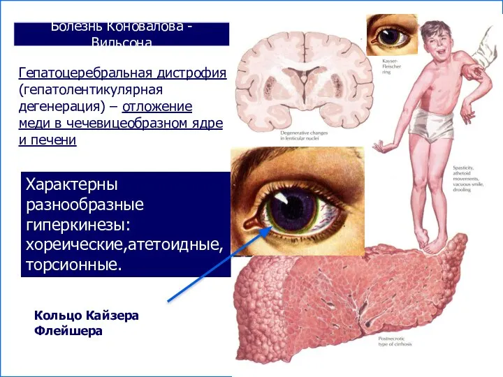 Болезнь Коновалова - Вильсона Гепатоцеребральная дистрофия (гепатолентикулярная дегенерация) – отложение меди