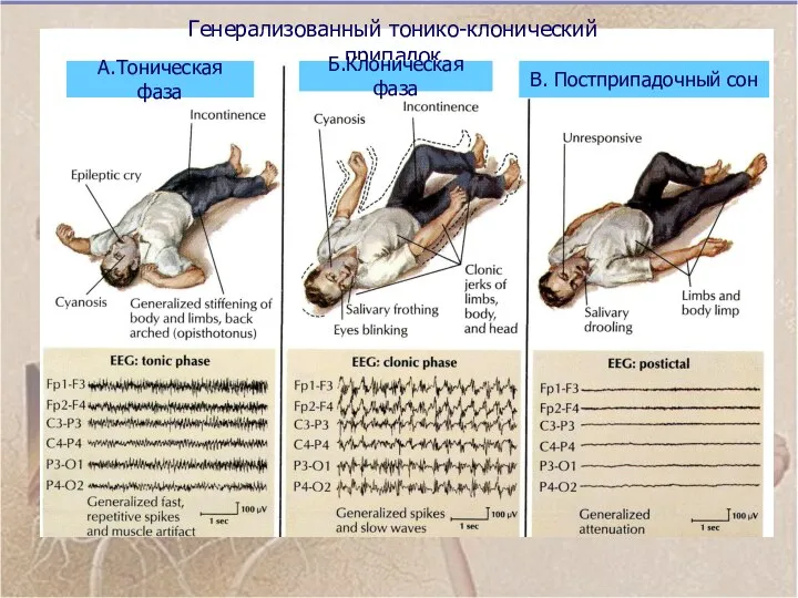 Генерализованный тонико-клонический припадок А.Тоническая фаза Б.Клоническая фаза В. Постприпадочный сон