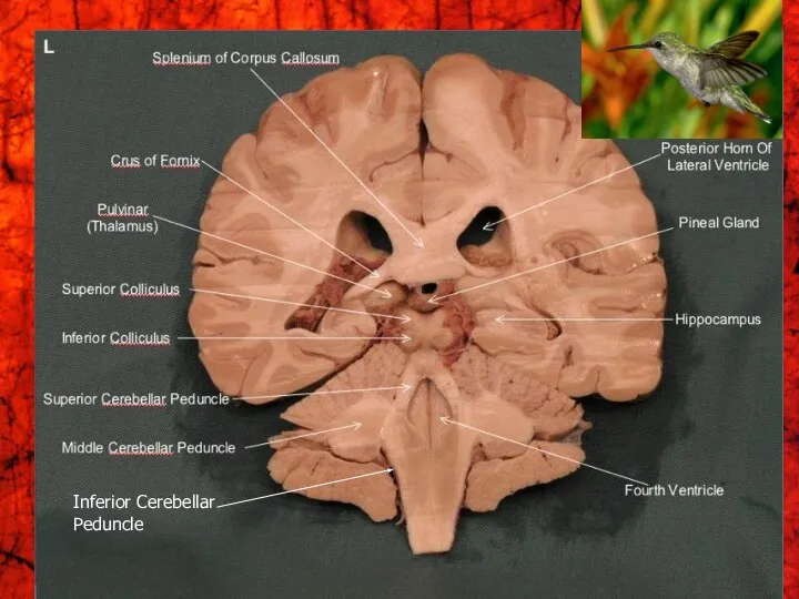 Inferior Cerebellar Peduncle