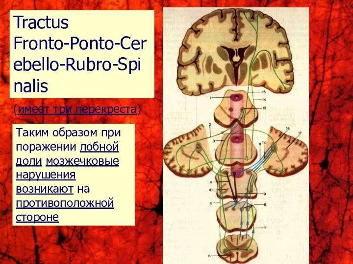 Tractus Fronto-Ponto-Cerebello-Rubro-Spinalis (имеет три перекреста) Таким образом при поражении лобной доли