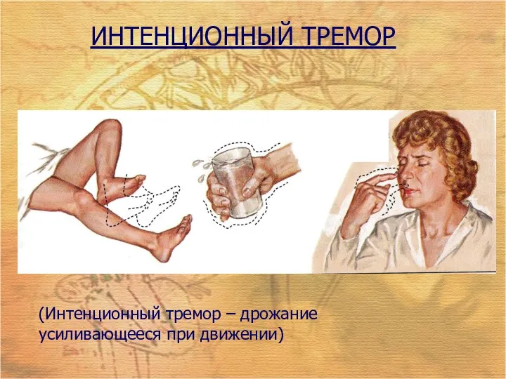 ИНТЕНЦИОННЫЙ ТРЕМОР (Интенционный тремор – дрожание усиливающееся при движении)