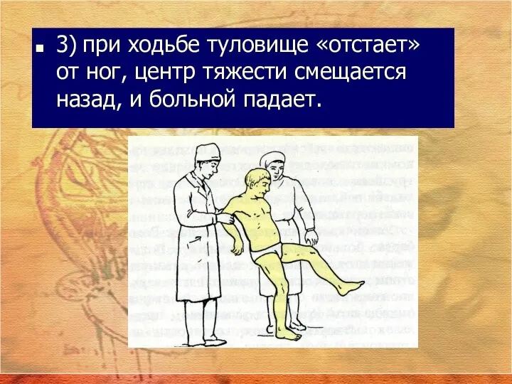 3) при ходьбе туловище «отстает» от ног, центр тяжести смещается назад, и больной падает.