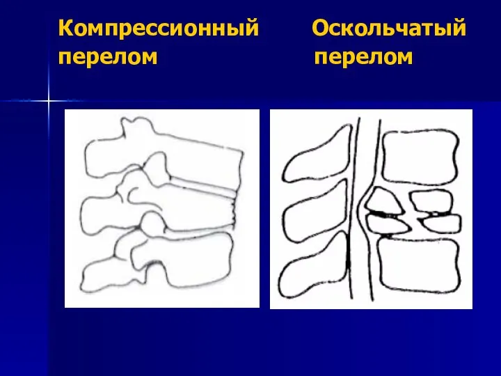 Компрессионный Оскольчатый перелом перелом