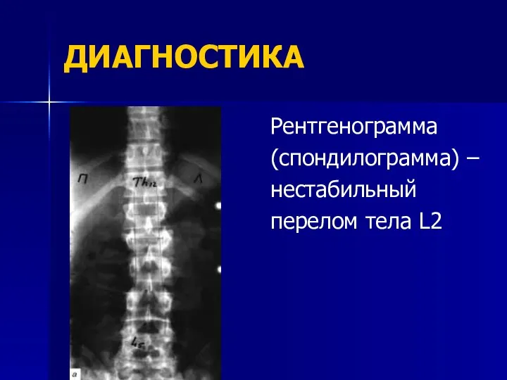 ДИАГНОСТИКА Рентгенограмма (спондилограмма) – нестабильный перелом тела L2