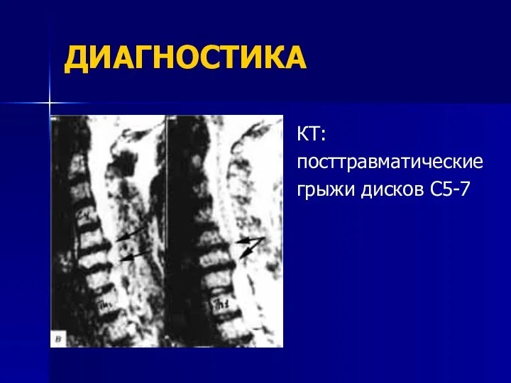 ДИАГНОСТИКА КТ: посттравматические грыжи дисков С5-7