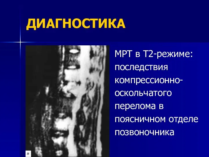 ДИАГНОСТИКА МРТ в Т2-режиме: последствия компрессионно- оскольчатого перелома в поясничном отделе позвоночника