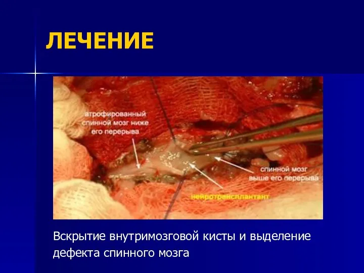 ЛЕЧЕНИЕ Вскрытие внутримозговой кисты и выделение дефекта спинного мозга