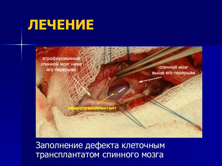 ЛЕЧЕНИЕ Заполнение дефекта клеточным трансплантатом спинного мозга