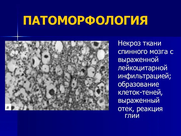 ПАТОМОРФОЛОГИЯ Некроз ткани спинного мозга с выраженной лейкоцитарной инфильтрацией; образование клеток-теней, выраженный отек, реакция глии