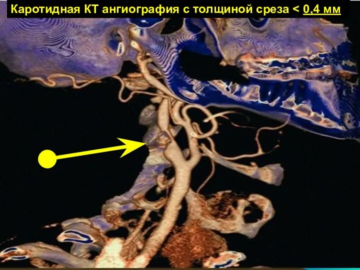 Каротидная КТ ангиография с толщиной среза