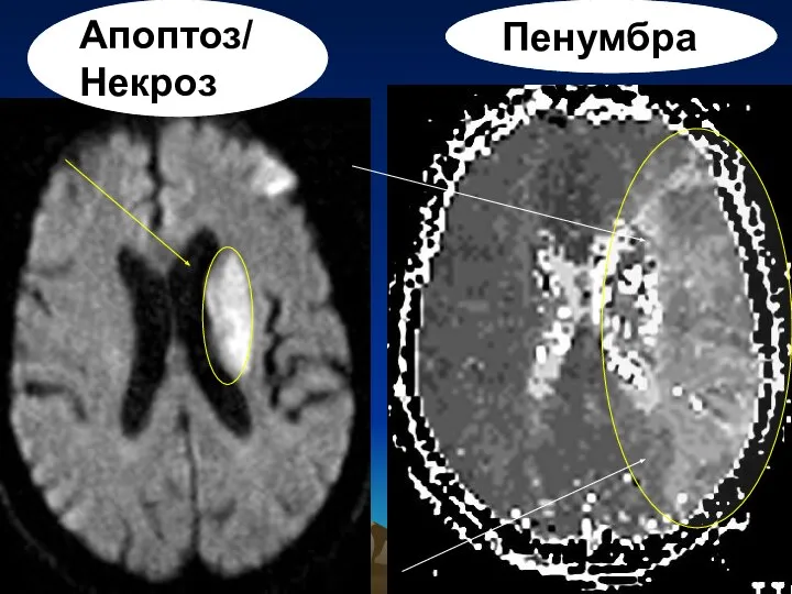 Апоптоз/ Некроз Пенумбра