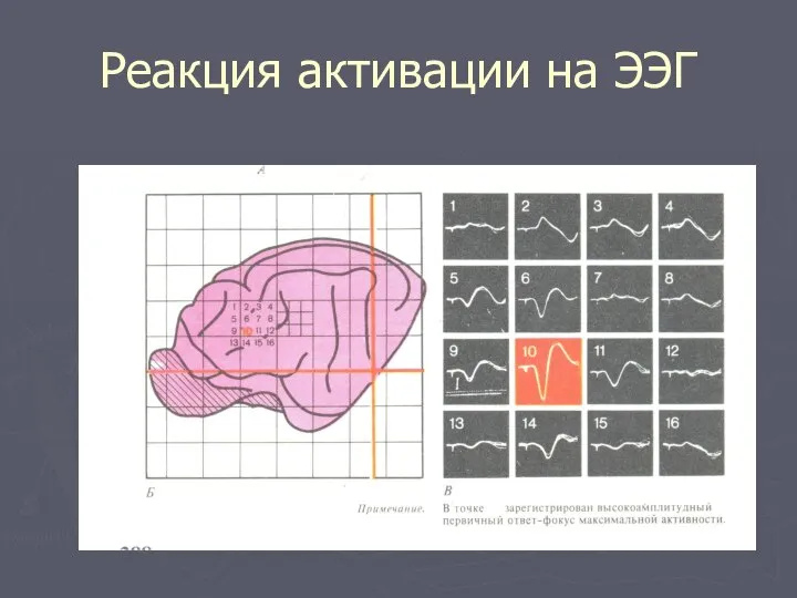 Реакция активации на ЭЭГ