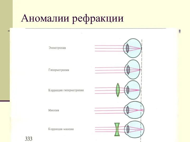 Аномалии рефракции