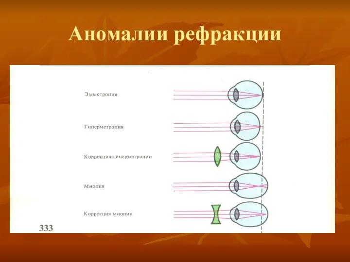 Аномалии рефракции