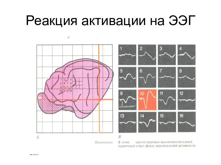 Реакция активации на ЭЭГ