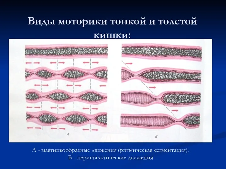 Виды моторики тонкой и толстой кишки: А - маятникообразные движения (ритмическая сегментация); Б - перистальтические движения