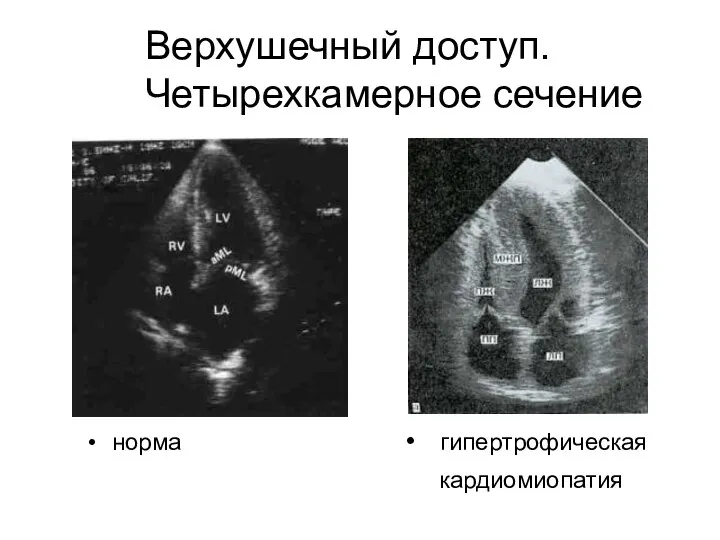 Верхушечный доступ. Четырехкамерное сечение норма • гипертрофическая кардиомиопатия