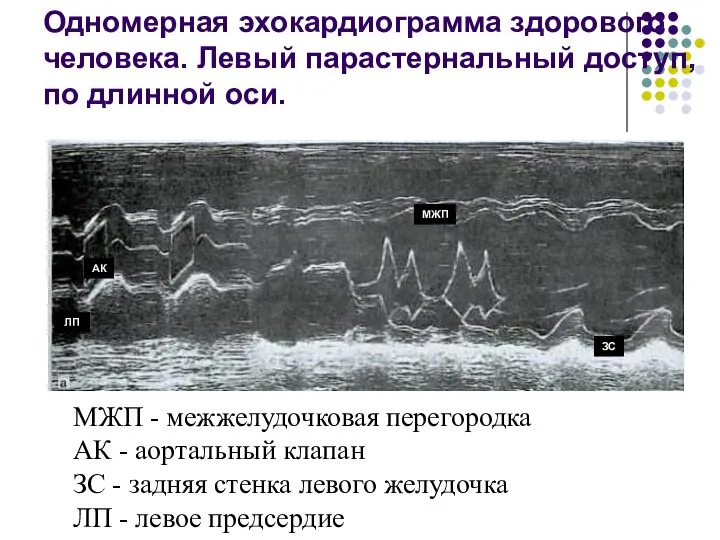 Одномерная эхокардиограмма здорового человека. Левый парастернальный доступ, по длинной оси. МЖП