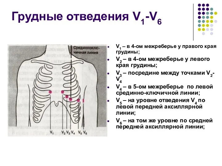 Грудные отведения V1-V6 V1 – в 4-ом межреберье у правого края