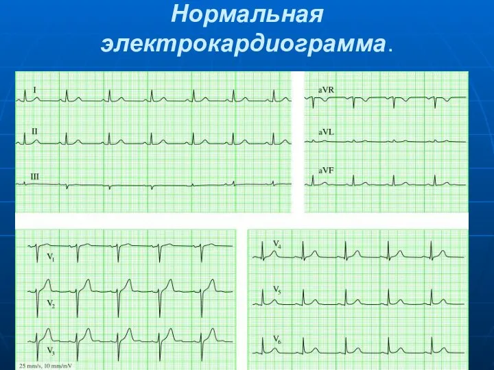 Нормальная электрокардиограмма.