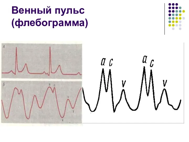 Венный пульс (флебограмма)