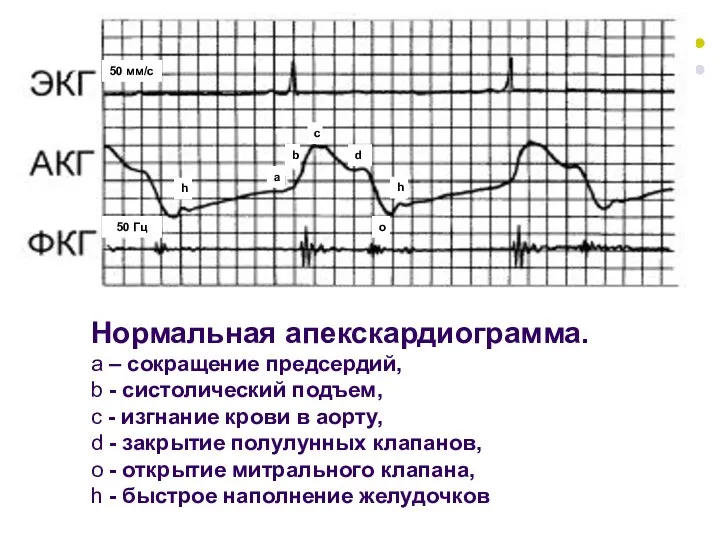 Нормальная апекскардиограмма. а – сокращение предсердий, b - cистолический подъем, с