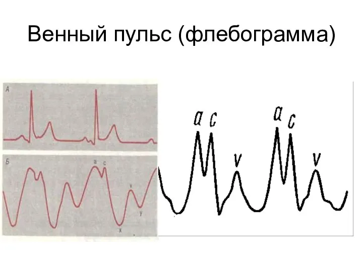 Венный пульс (флебограмма)