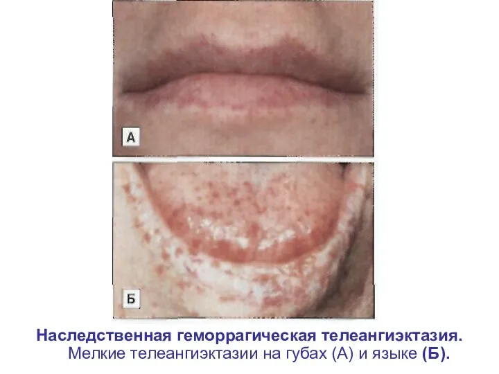 Наследственная геморрагическая телеангиэктазия. Мелкие телеангиэктазии на губах (А) и языке (Б).