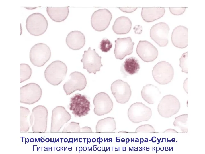 Тромбоцитодистрофия Бернара-Сулье. Гигантские тромбоциты в мазке крови