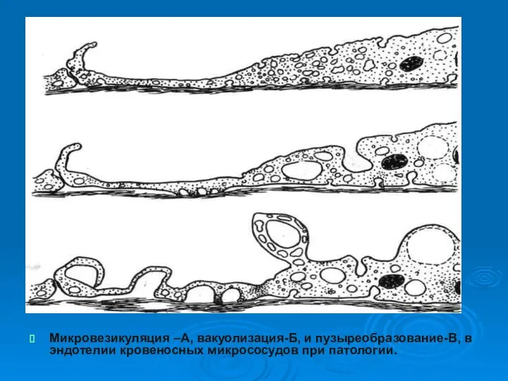 Микровезикуляция –А, вакуолизация-Б, и пузыреобразование-В, в эндотелии кровеносных микрососудов при патологии.