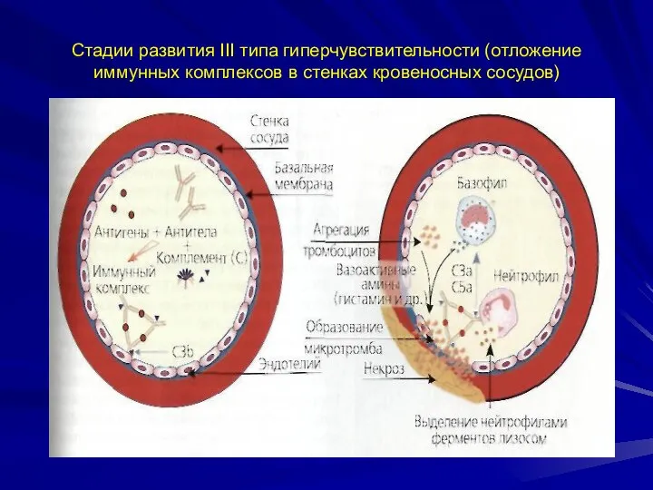 Стадии развития III типа гиперчувствительности (отложение иммунных комплексов в стенках кровеносных сосудов)